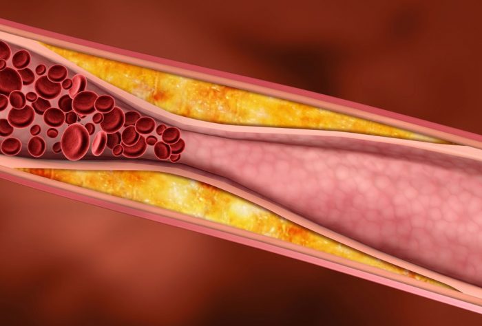 aterosclerosis