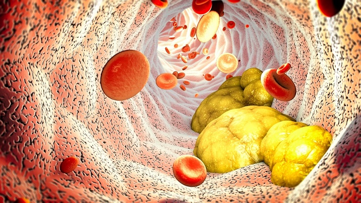 La combinación de estatinas y ezetimiba consigue mayores reducciones de los niveles de colesterol