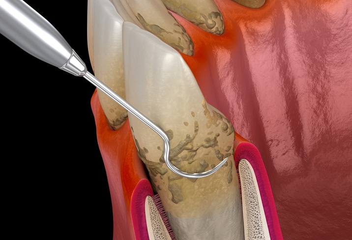 periodontitis