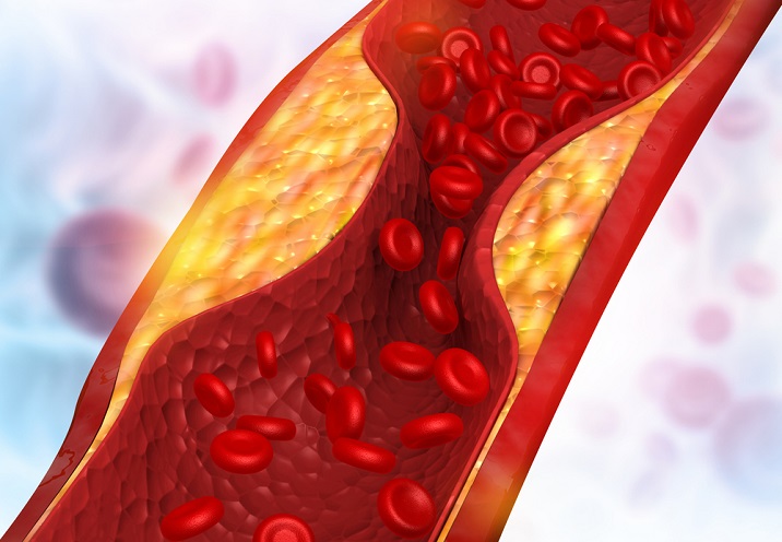 El cLDL elevado se relaciona directamente con aterosclerosis y enfermedad cardiovascular