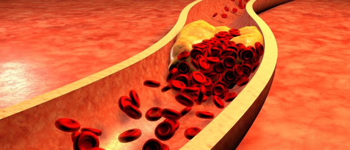 El cLDL bajo reduce la morbimortalidad cardiovascular