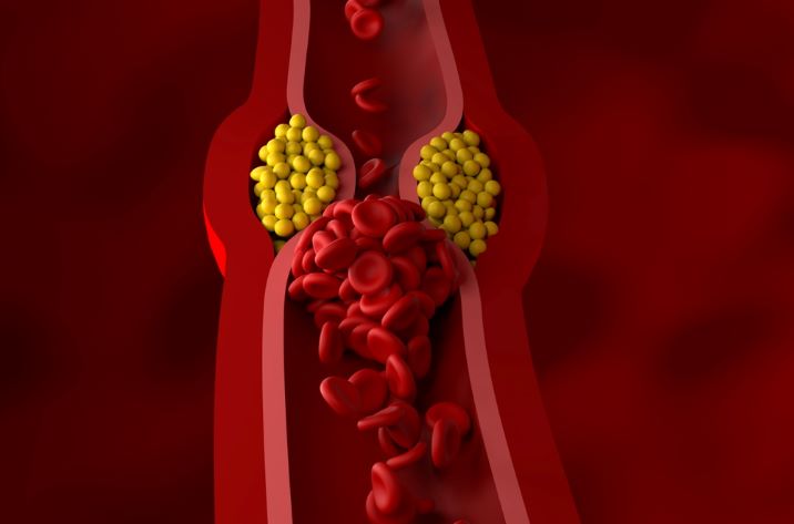 El control del cLDL reduce la morbimortalidad cardiovascular